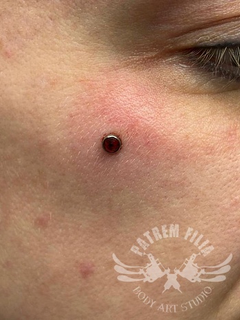 Micro dermal
