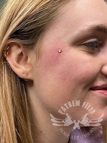 Micro dermal op diverse plaatsen