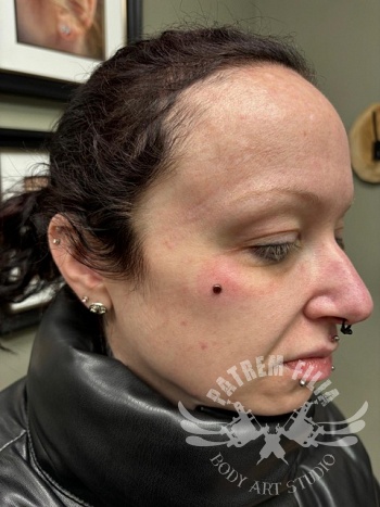 Micro dermal op wang