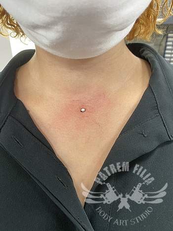 Microdermal op borst